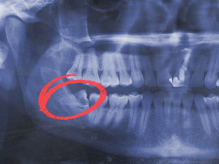 20lik diş röntgen