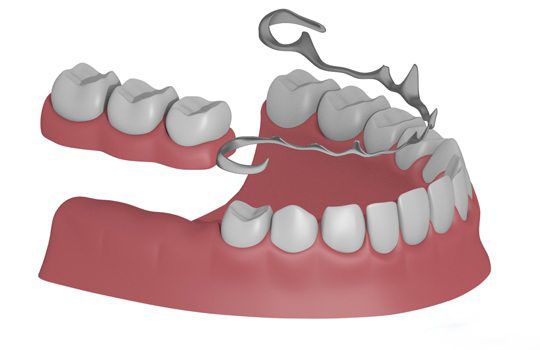 parsiyel diş protezi